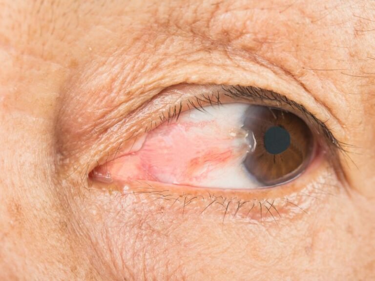 Cirurgia de Pterigio em Campos dos Goytacazes Solucao Definitiva