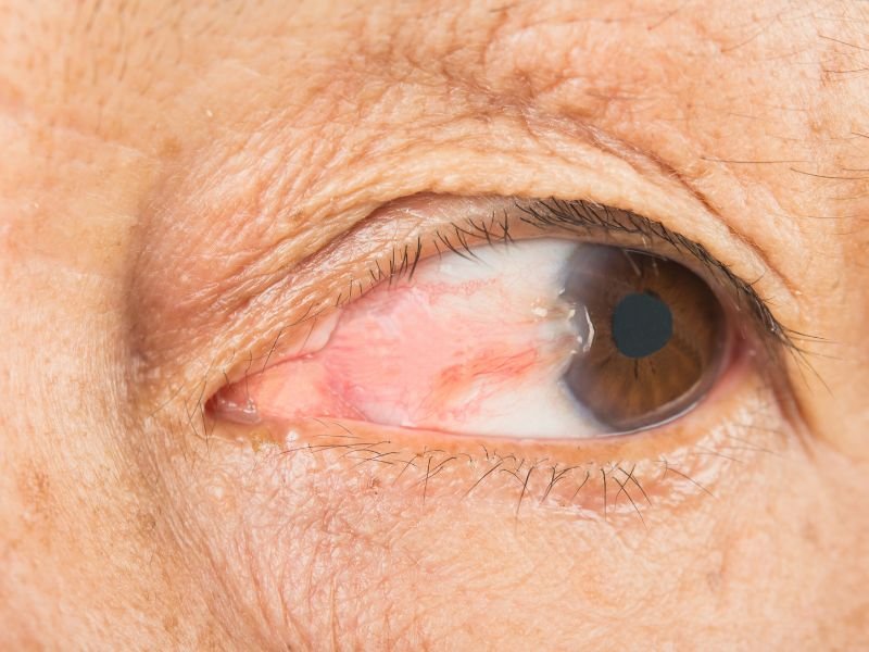 Cirurgia de Pterigio em Campos dos Goytacazes Solucao Definitiva